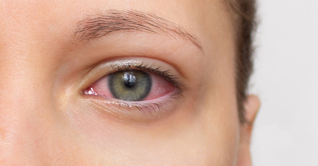 A close up of a red, irritated eye. The eyelid and skin around the eye are swollen and irritated as well.